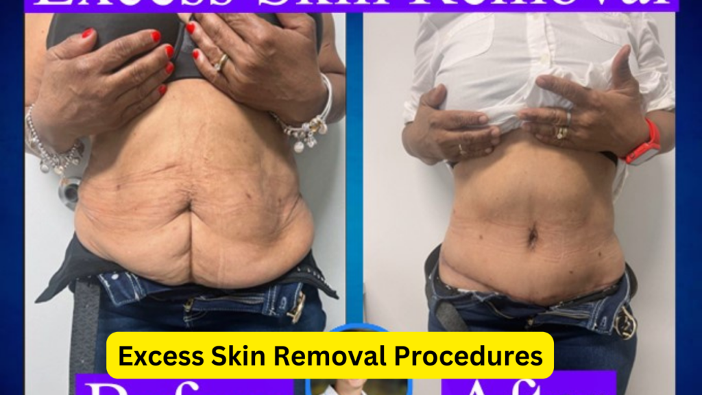 Excess Skin Removal Procedures